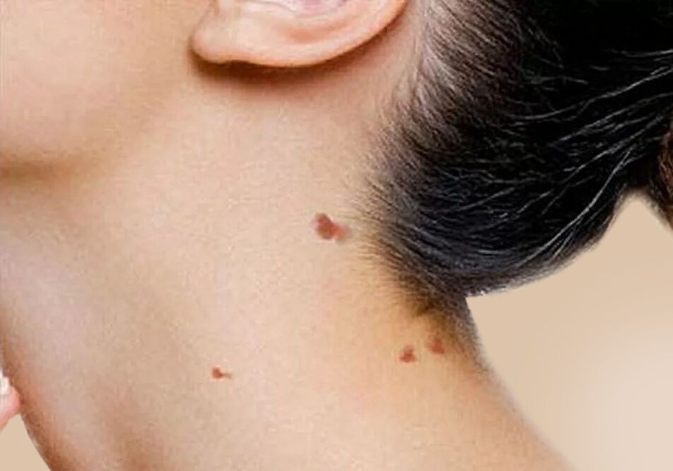 L'apparition de papillomes sur le cou après activation dans le corps du VPH