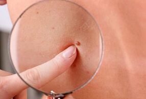 raisons de l'apparition de papillomes sur le corps humain