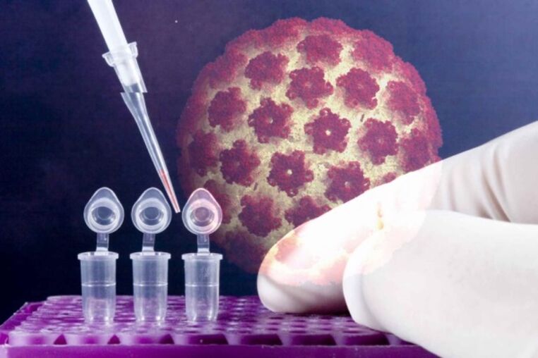 diagnostic de papillomes